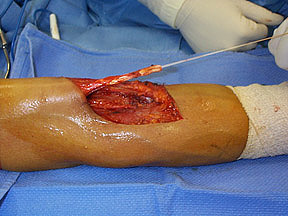 tendon biceps repair surgery bicep distal torn elbow cast splint ihmc hand